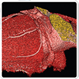 The Practice of Catheter Cryoablation for Cardiac Arrhythmias
